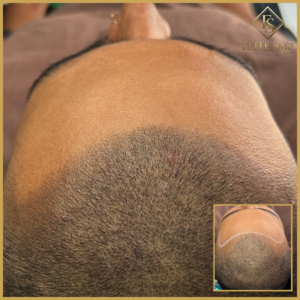 Hairline Restoration (Thinning Hairline)