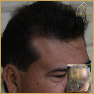 Crown Restoration (Thinning Crown)