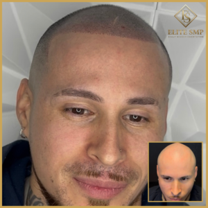 Full SMP Restoration (Completely Bald)